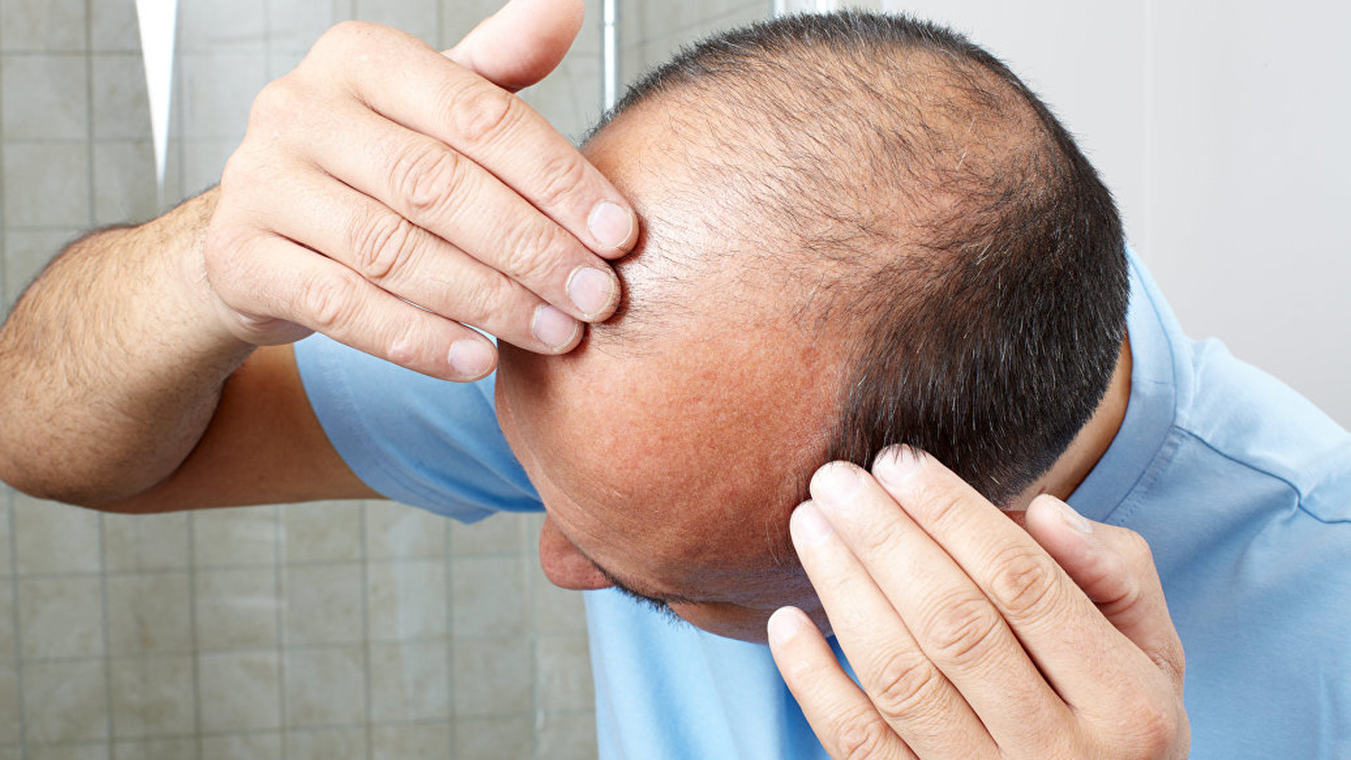Как восстановить рост волос на полысевших участках головы у мужчины