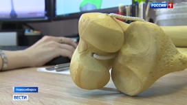 Новосибирские врачи поставили жительнице Казахстана напечатанные на 3D-принтере протезы