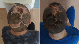 Врачи в Челябинске восстановили волосы ребенку, которого искусали собаки