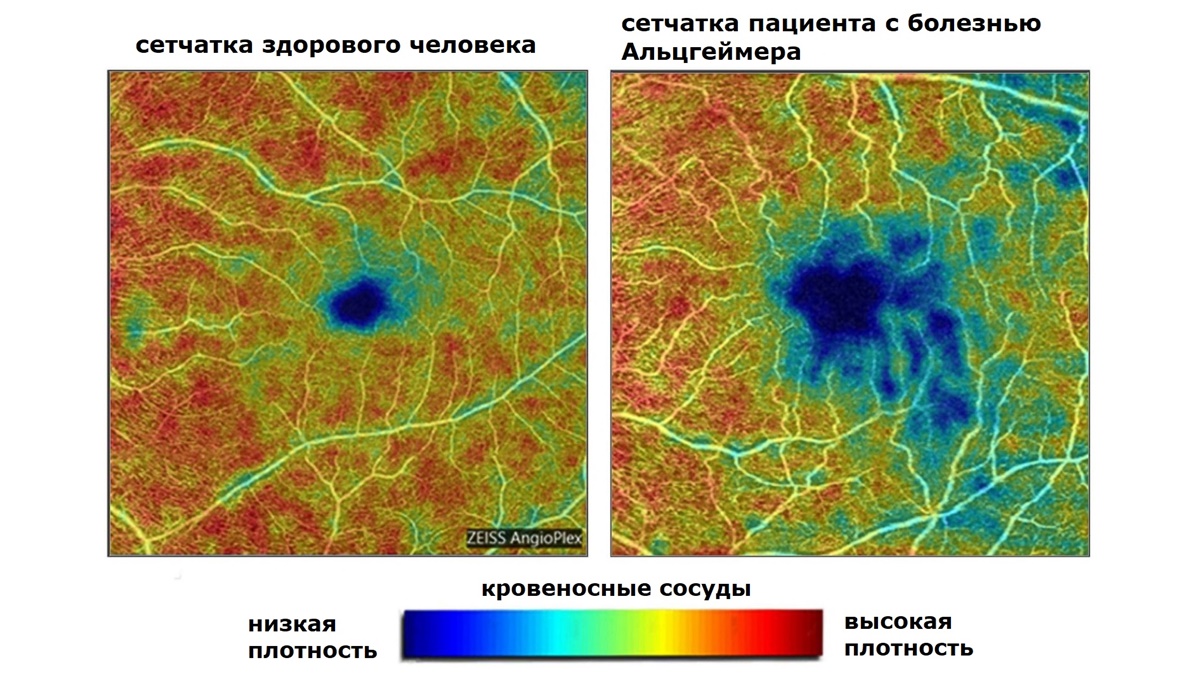 Изображения получены с помощью оптической когерентной томографии с ангиографией.