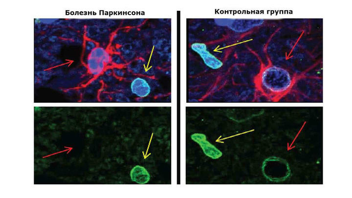 Ядра стареющих клеток теряют определённый белок, обозначенный выше зелёным цветом. Этот белок теряется из астроцитов (красные клетки), но не из соседних клеток.